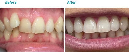 Patient before and after 2