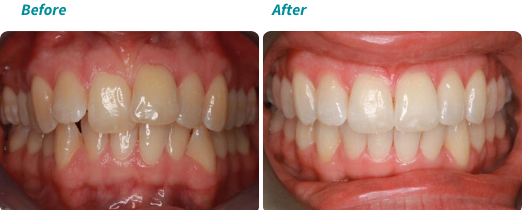 Patient before and after 3