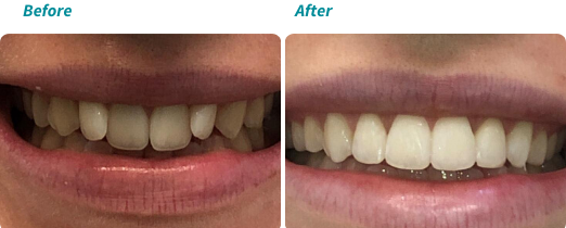 Patient before and after 4